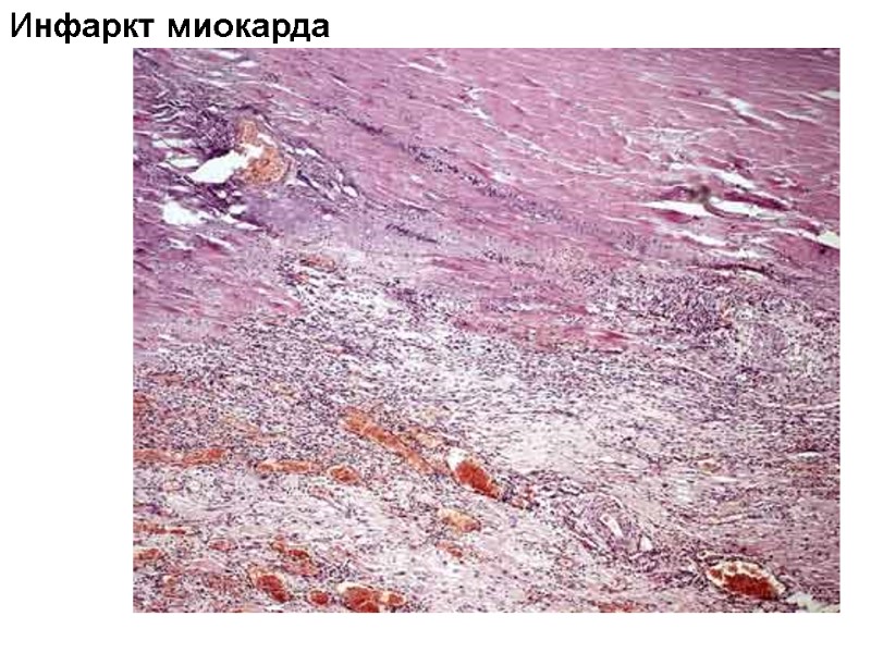 Инфаркт миокарда